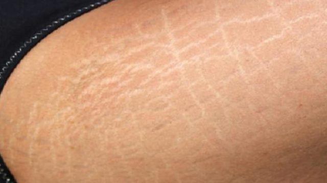 كيف تتخلصين من السيلوليت