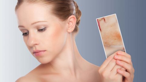 تخلصي من حب الشباب في الوجه بهذه المكونات الطبيعية