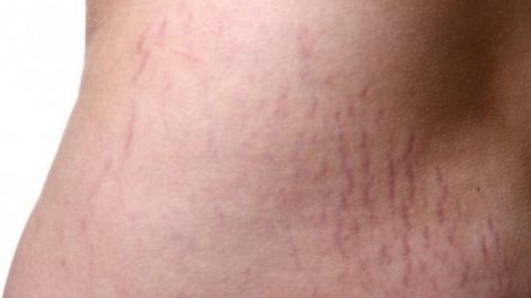 طرق بسيطة للتخلص من مشكلة السيلوليت نهائيًا