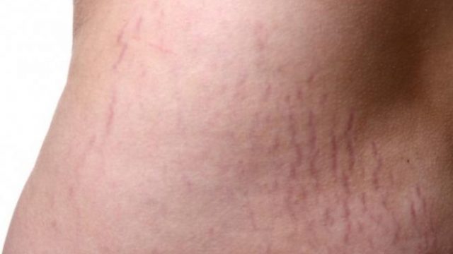 طرق بسيطة للتخلص من مشكلة السيلوليت نهائيًا