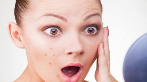 تجنبي هذه الأطعمة للتخلص من حب الشباب