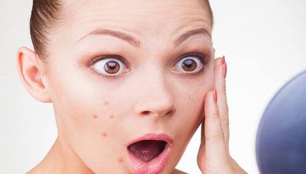 تجنبي هذه الأطعمة للتخلص من حب الشباب