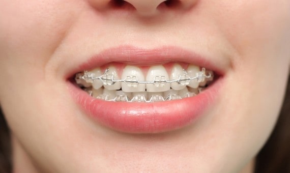 كيف تتعاملين مع آلام تقويم الأسنان؟