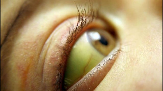 أمراض تسبب اصفرار العين.. اكتشفيها