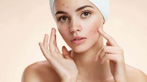 أفضل الوصفات المنزلية لعلاج حب الشباب