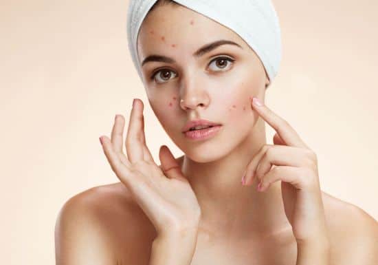 أفضل الوصفات المنزلية لعلاج حب الشباب