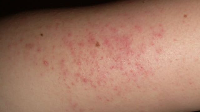 خطوات بسيطة للتخلص من الحبوب الحمراء الجافة على الذراعين