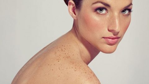 علاجات طبيعية للتخلص من النمش