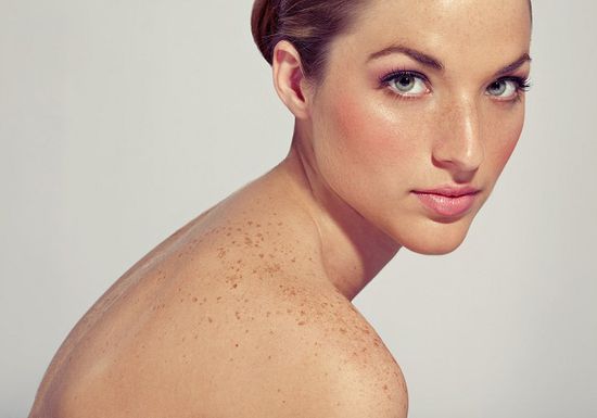 علاجات طبيعية للتخلص من النمش