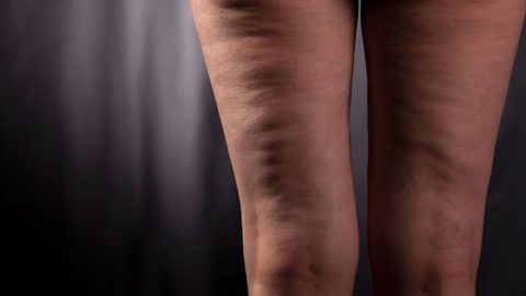 السيلولايت و طرق الوقاية منه