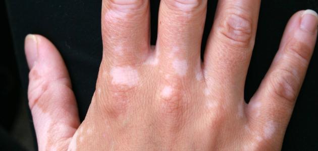 أطعمة تساعد على علاج مرض البهاق