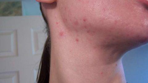 نصائح لتجنب حبوب الذقن المزعجة