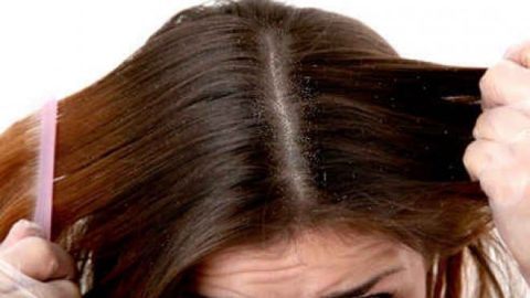5 طرق طبيعية لمكافحة قشرة الشعر