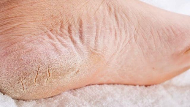 أسباب و طرق علاج تشقق القدمين