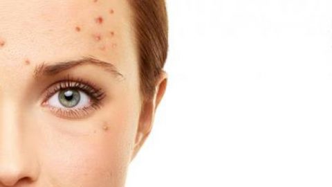 اكتشفي مشاكلك الصحية حسب أماكن الحبوب في وجهك