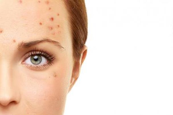 اكتشفي مشاكلك الصحية حسب أماكن الحبوب في وجهك