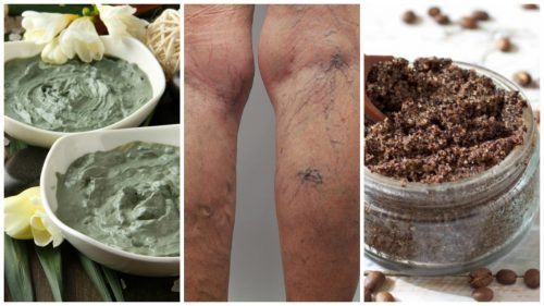 6-remedes-maison-pour-eliminer-les-varices-500x281