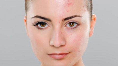 6 أسباب خفية وراء ظهور حب الشباب