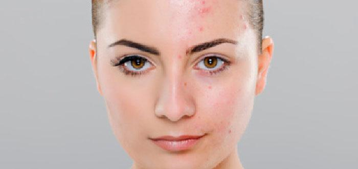 6 أسباب خفية وراء ظهور حب الشباب