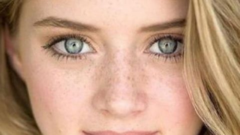 تخلصي من النمش بسهولة من خلال وصفة الخل وعصير البصل