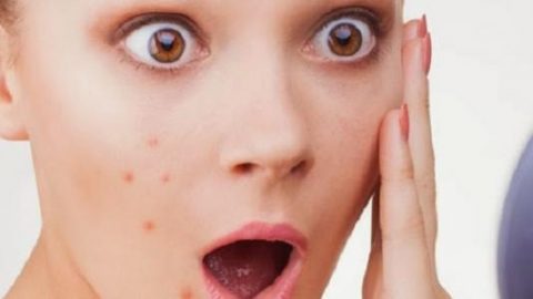 وصفات طبيعية فعالة  للتخلص من آثار حب الشباب