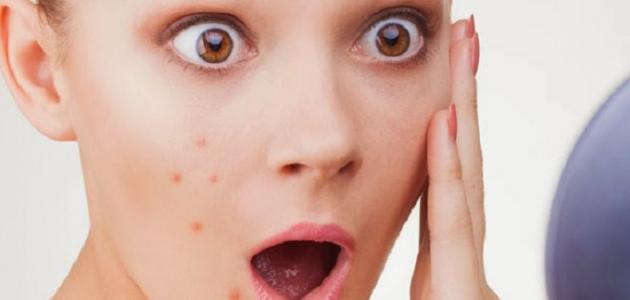 وصفات طبيعية فعالة  للتخلص من آثار حب الشباب