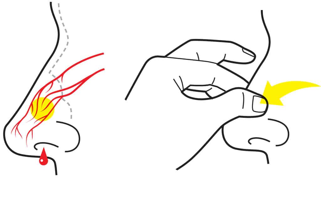 علاج نزيف الأنف