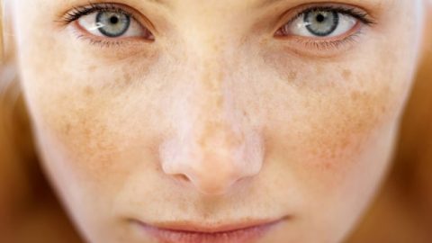 نصائح للتخلص من النمش