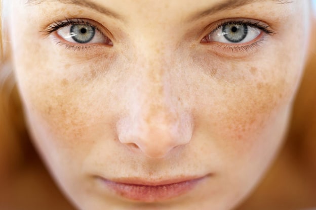 نصائح للتخلص من النمش