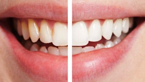 تعرفي على هذا المكون الطبيعي المثالي لتبييض أسنانك
