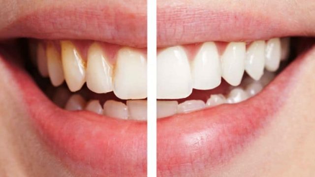 تعرفي على هذا المكون الطبيعي المثالي لتبييض أسنانك