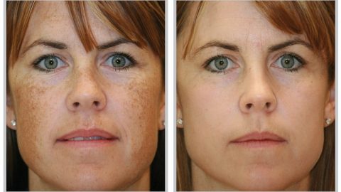 كيف تزيلين البقع التي تظهر مع التقدم في السن؟