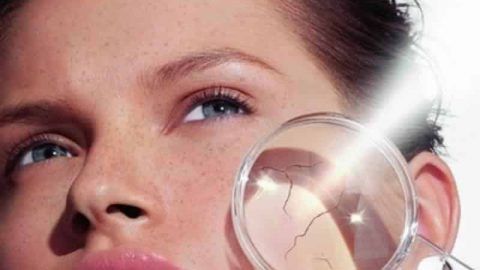 طرق سهلة وبسيطة لعلاج حروق الشمس