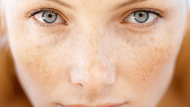 خلطات طبيعية للتخلص من كلف الحمل