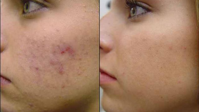 وصفات سهلة من مكونات طبيعية للتخلص من آثار الحبوب والبثور