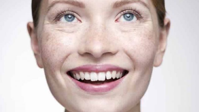 وصفات طبيعية لعلاج الكلف لدى الحامل