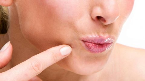 علاج فعال وطبيعي للقضاء على حب الشباب في الذقن