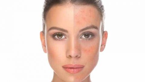 عالجي احمرار الوجه بهذه الوصفات الطبيعية