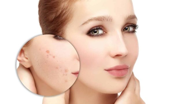 هل جربت وصفة الحناء لعلاج آثار حب الشباب من قبل؟