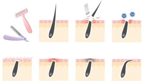 تخلصي من نمو الشعر تحت الجلد بطريقة سهلة