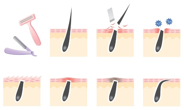 تخلصي من نمو الشعر تحت الجلد بطريقة سهلة