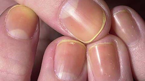 حيلة فعالة للتخلص من اصفرار الأظافر