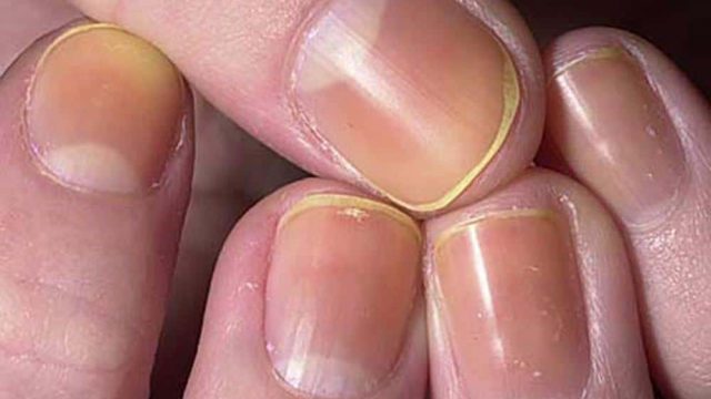 حيلة فعالة للتخلص من اصفرار الأظافر