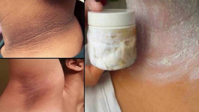 خلطة تخلصك من سواد الرقبة والإبطين نهائيا