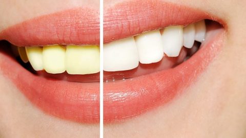 طرق طبيعية لتبييض أسنانك في المنزل