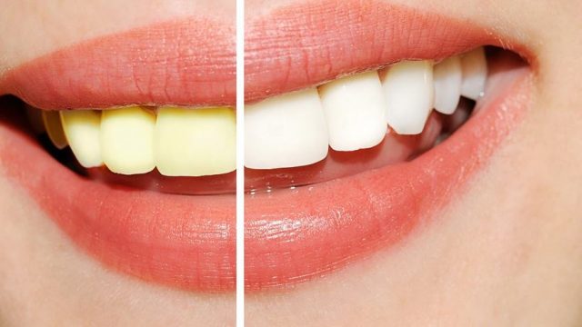 طرق طبيعية لتبييض أسنانك في المنزل