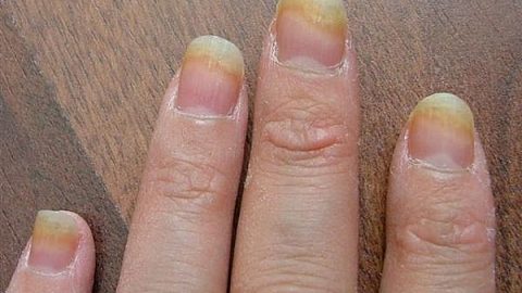 علاج الكركم لمكافحة الأظافر الفطرية