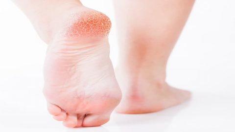 مكونين فقط من مطبخك لعلاج تشقق القدمين