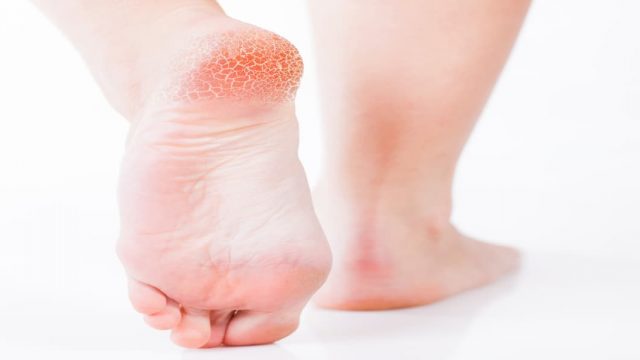 مكونين فقط من مطبخك لعلاج تشقق القدمين