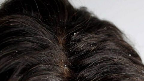 وصفة البقدونس للتخلص من قشرة الشعر في أسبوع واحد فقط